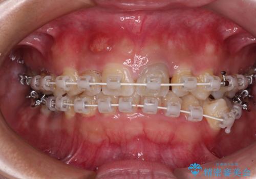 歯列から飛び出た歯　ワイヤー矯正で整った歯列にの治療中