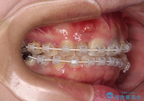 歯列から飛び出た歯　ワイヤー矯正で整った歯列にの治療中
