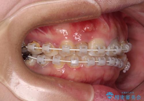 歯列から飛び出た歯 ワイヤー矯正で整った歯列にの治療中