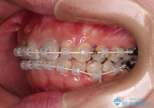 歯列から飛び出た歯 ワイヤー矯正で整った歯列にの治療中