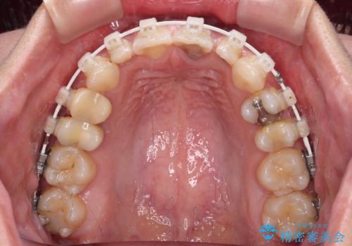 歯列から飛び出た歯 ワイヤー矯正で整った歯列にの治療中