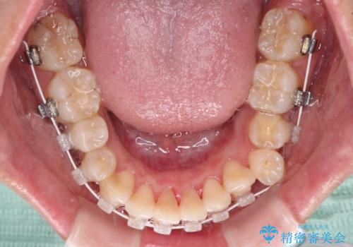 歯列から飛び出た歯 ワイヤー矯正で整った歯列にの治療中