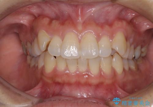 気になる八重歯　ワイヤー装置での非抜歯矯正の症例 治療前
