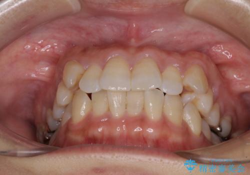 気になる八重歯 ワイヤー装置での非抜歯矯正の治療前