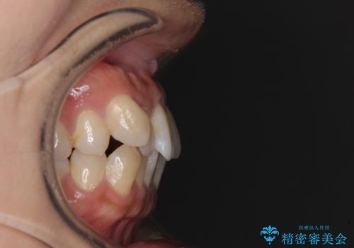 気になる八重歯 ワイヤー装置での非抜歯矯正の治療前