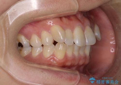 気になる八重歯　ワイヤー装置での非抜歯矯正の治療前