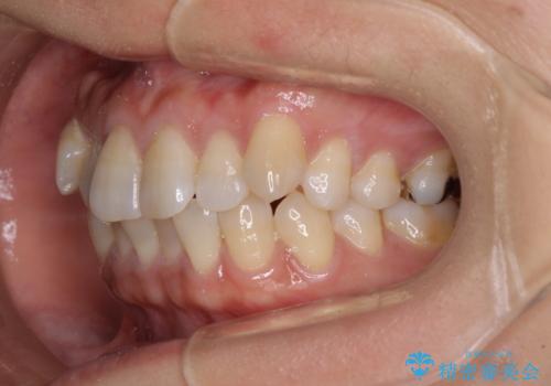 気になる八重歯 ワイヤー装置での非抜歯矯正の治療前