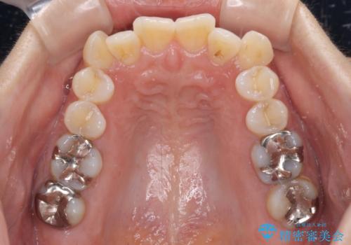 気になる八重歯 ワイヤー装置での非抜歯矯正の治療前