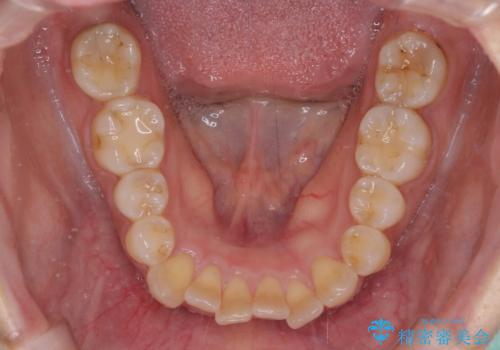 気になる八重歯 ワイヤー装置での非抜歯矯正の治療前