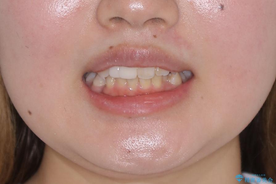 前歯の不自然なセラミック 下のすきっ歯 矯正治療で総合的に美しくの治療前(顔貌)