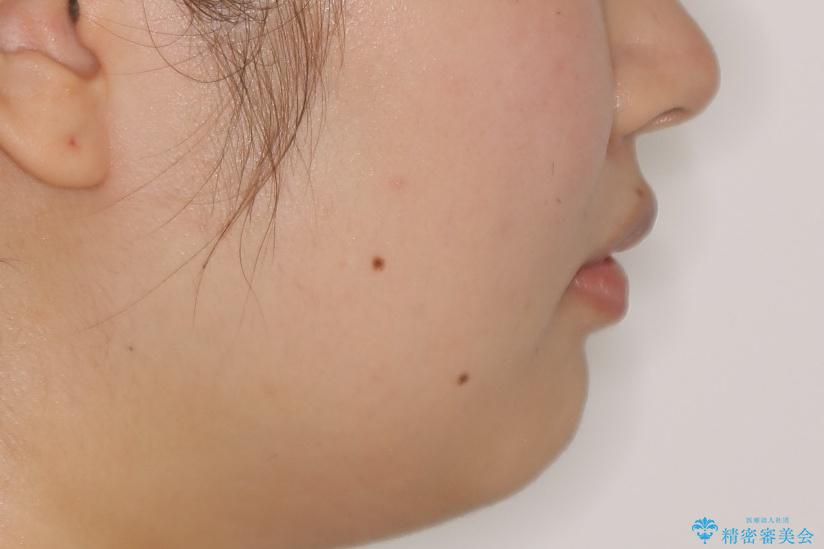 前歯の不自然なセラミック 下のすきっ歯 矯正治療で総合的に美しくの治療前(顔貌)