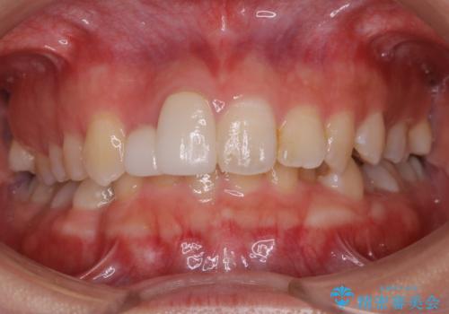 前歯の不自然なセラミック　下のすきっ歯　矯正治療で総合的に美しくの症例 治療前