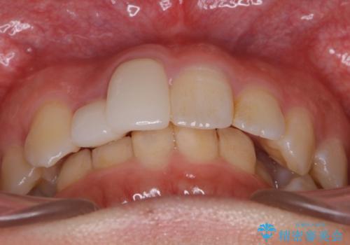 前歯の不自然なセラミック　下のすきっ歯　矯正治療で総合的に美しくの治療前
