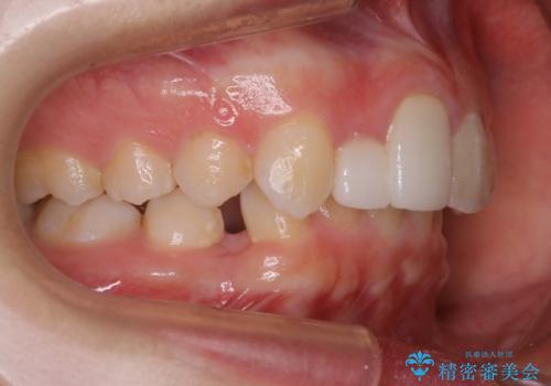 前歯の不自然なセラミック　下のすきっ歯　矯正治療で総合的に美しくの治療前