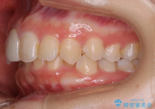 前歯の不自然なセラミック 下のすきっ歯 矯正治療で総合的に美しくの治療前
