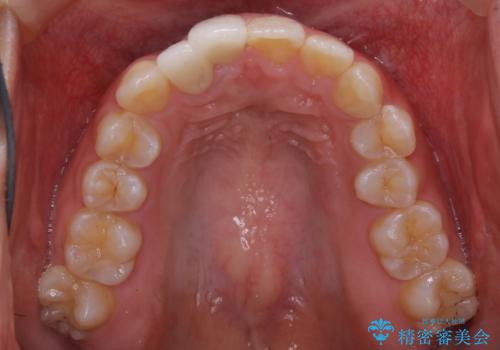 前歯の不自然なセラミック 下のすきっ歯 矯正治療で総合的に美しくの治療前