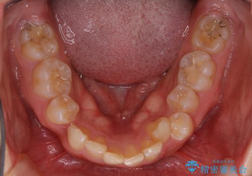 前歯の不自然なセラミック 下のすきっ歯 矯正治療で総合的に美しくの治療前