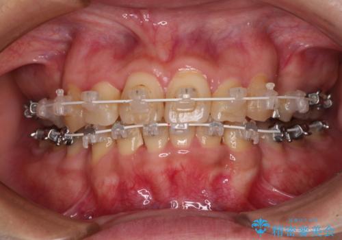治療途中で帰国 装置をつけた状態を継続して矯正治療の治療中