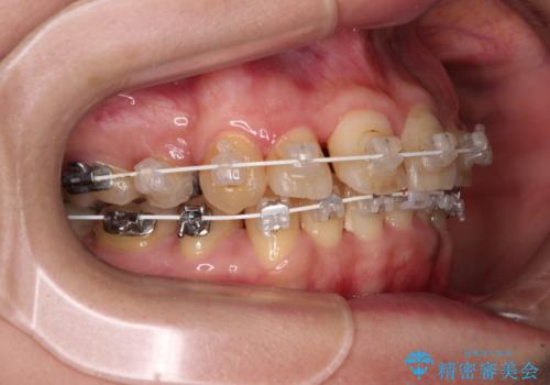 治療途中で帰国 装置をつけた状態を継続して矯正治療の治療中