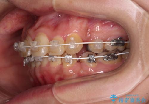 治療途中で帰国 装置をつけた状態を継続して矯正治療の治療中