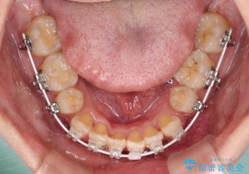 治療途中で帰国 装置をつけた状態を継続して矯正治療の治療中