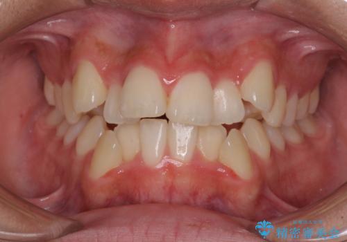上顎骨幅が狭い　急速拡大装置を併用した抜歯矯正の症例 治療前