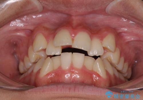 上顎骨幅が狭い 急速拡大装置を併用した抜歯矯正の治療前