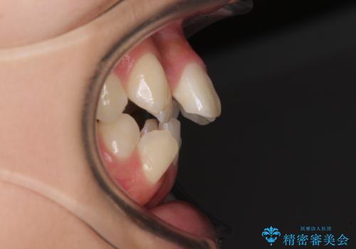 上顎骨幅が狭い　急速拡大装置を併用した抜歯矯正の治療前