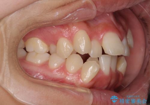 上顎骨幅が狭い 急速拡大装置を併用した抜歯矯正の治療前