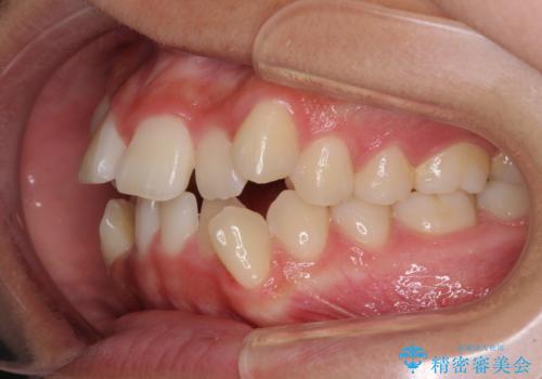 上顎骨幅が狭い 急速拡大装置を併用した抜歯矯正の治療前