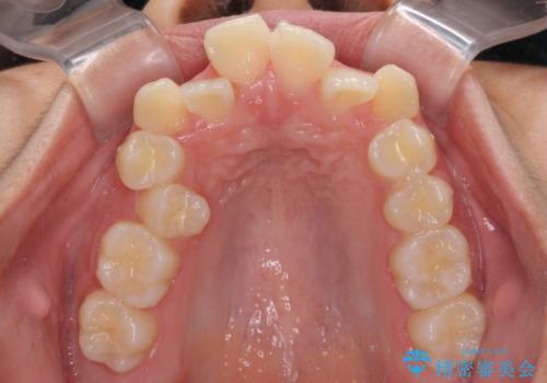 上顎骨幅が狭い 急速拡大装置を併用した抜歯矯正の治療前