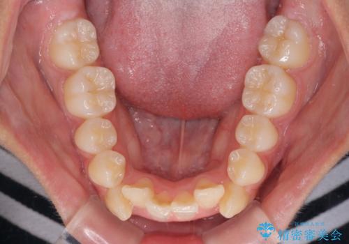 上顎骨幅が狭い 急速拡大装置を併用した抜歯矯正の治療前