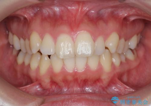 不安定な噛み合わせを改善 マウスピース矯正治療の治療前