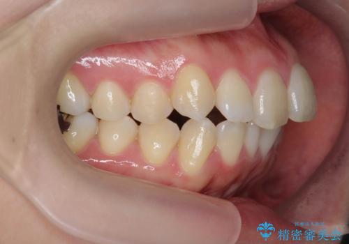 不安定な噛み合わせを改善 マウスピース矯正治療の治療前