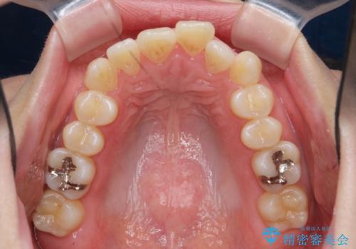 不安定な噛み合わせを改善 マウスピース矯正治療の治療前