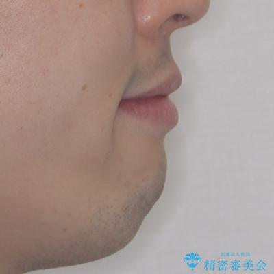 しゃくれて口が閉じられない ワイヤー装置での抜歯矯正の治療後(顔貌)