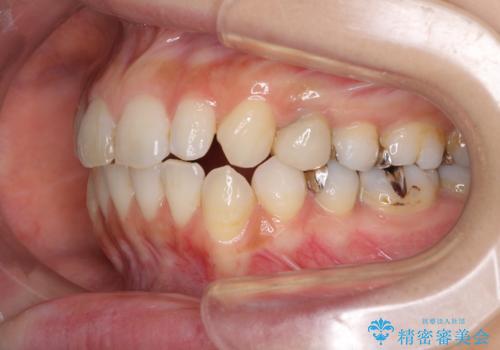 痛むむし歯と小さい歯とデコボコ　むし歯治療と矯正治療を並行した総合歯科治療の治療中