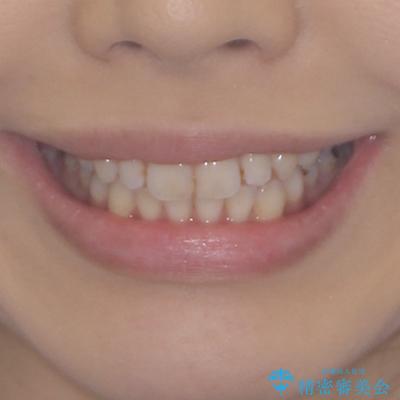 痛むむし歯と小さい歯とデコボコ むし歯治療と矯正治療を並行した総合歯科治療の治療後(顔貌)