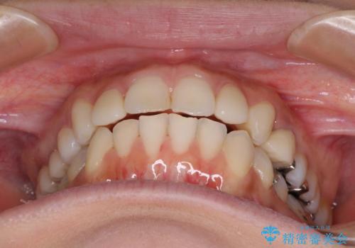 痛むむし歯と小さい歯とデコボコ　むし歯治療と矯正治療を並行した総合歯科治療の治療後