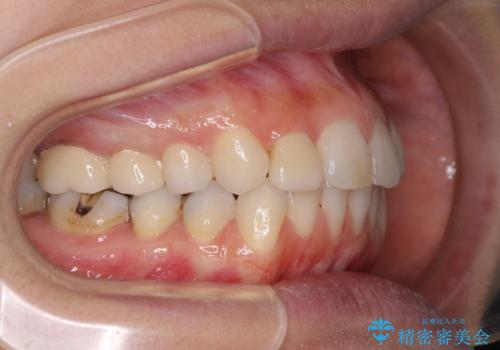 痛むむし歯と小さい歯とデコボコ　むし歯治療と矯正治療を並行した総合歯科治療の治療後