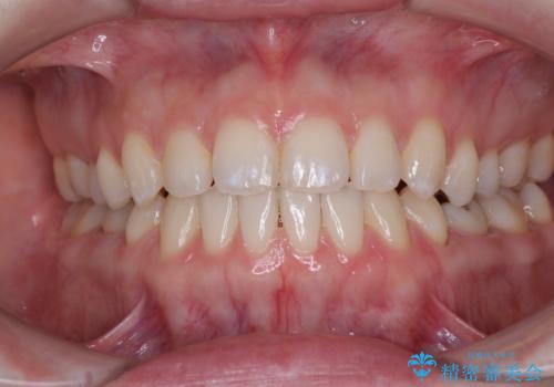 すきっ歯をインビザラインできれいな歯並びに改善の治療中