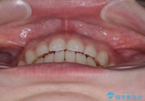 すきっ歯をインビザラインできれいな歯並びに改善の治療中