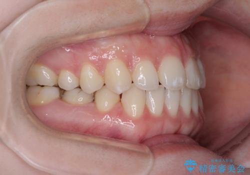 すきっ歯をインビザラインできれいな歯並びに改善の治療中