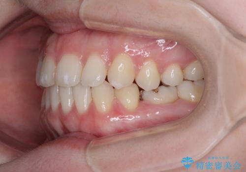 すきっ歯をインビザラインできれいな歯並びに改善の治療中