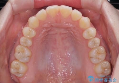 すきっ歯をインビザラインできれいな歯並びに改善の治療中