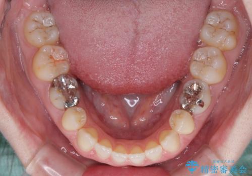 すきっ歯をインビザラインできれいな歯並びに改善の治療中