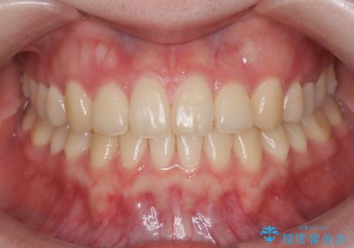 インビザラインとワイヤー矯正の併用で綺麗な歯並びに!の治療後