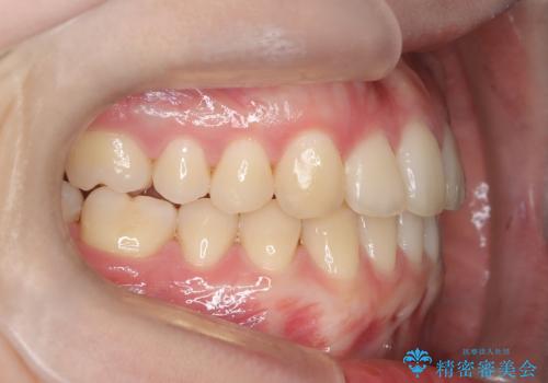 インビザラインとワイヤー矯正の併用で綺麗な歯並びに!の治療後