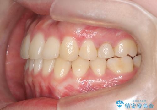 インビザラインとワイヤー矯正の併用で綺麗な歯並びに!の治療後