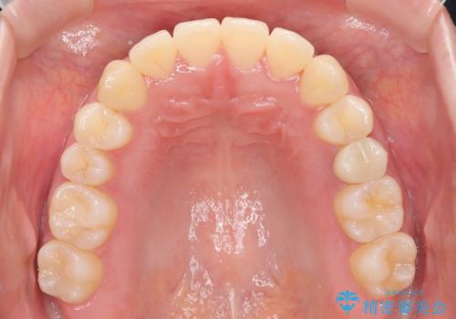 インビザラインとワイヤー矯正の併用で綺麗な歯並びに!の治療後